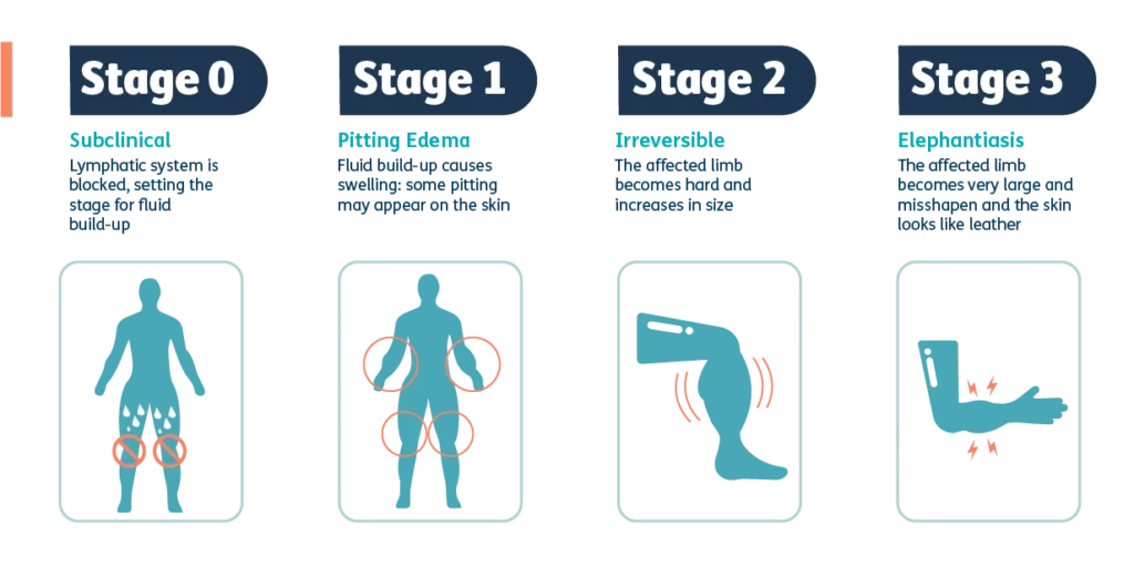 Stages of Lymphoedema